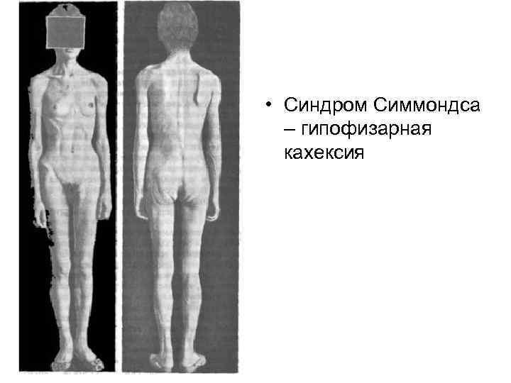 Синдром шиена презентация