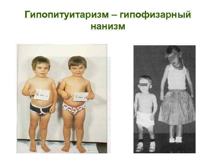 Гипопитуитаризм – гипофизарный нанизм 