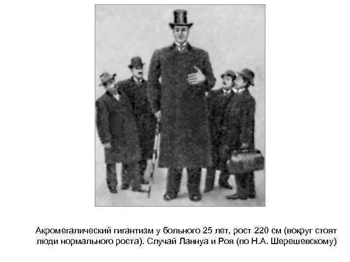 Акромегалический гигантизм у больного 25 лет, рост 220 см (вокруг стоят люди нормального роста).