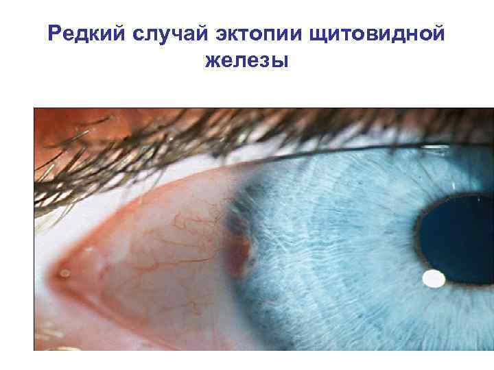 Редкий случай эктопии щитовидной железы 