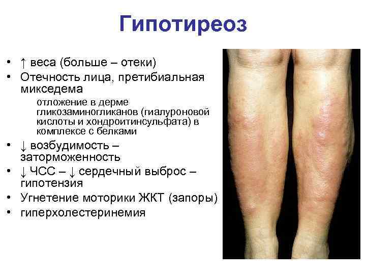 Гипотиреоз • ↑ веса (больше – отеки) • Отечность лица, претибиальная микседема отложение в