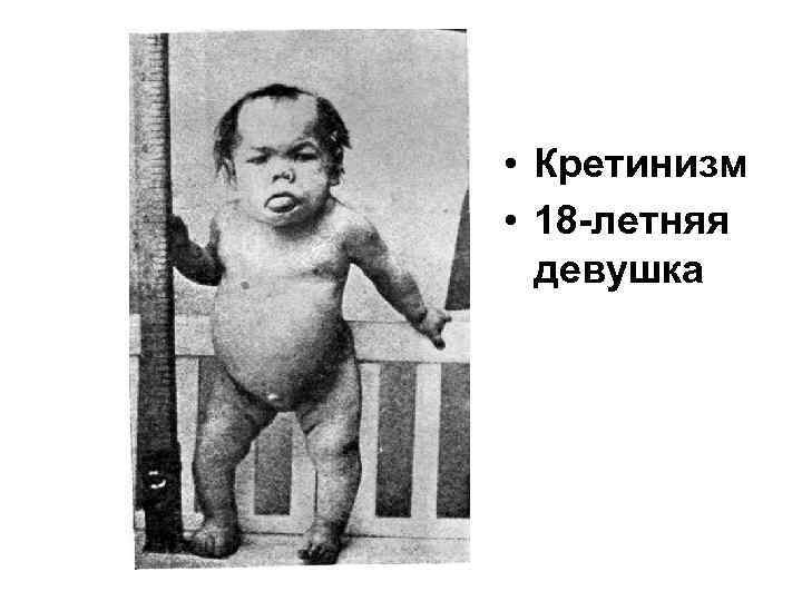  • Кретинизм • 18 -летняя девушка 