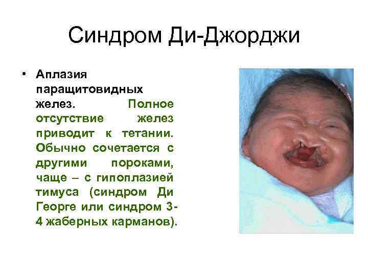 Синдром Ди-Джорджи • Аплазия паращитовидных желез. Полное отсутствие желез приводит к тетании. Обычно сочетается