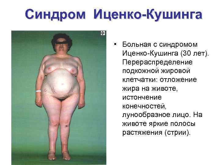Синдром Иценко-Кушинга • Больная с синдромом Иценко-Кушинга (30 лет). Перераспределение подкожной жировой клетчатки: отложение