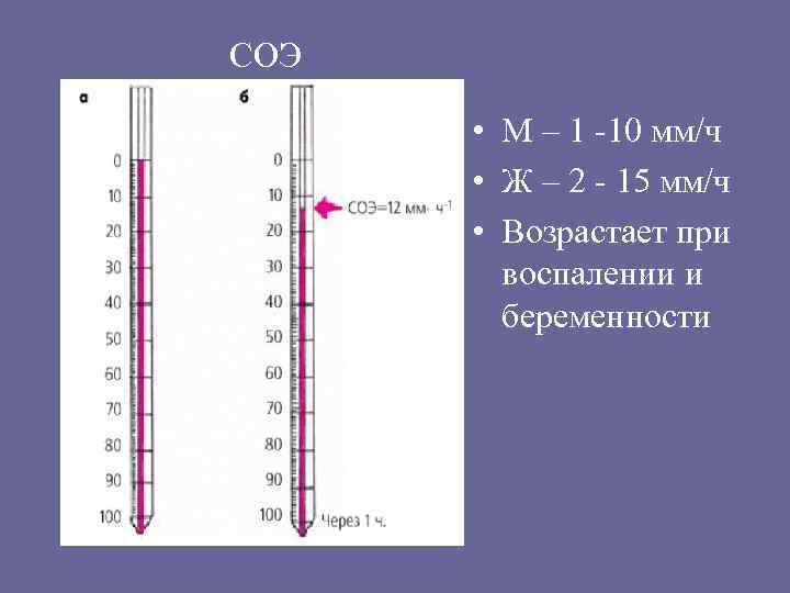 СОЭ • М – 1 -10 мм/ч • Ж – 2 - 15 мм/ч