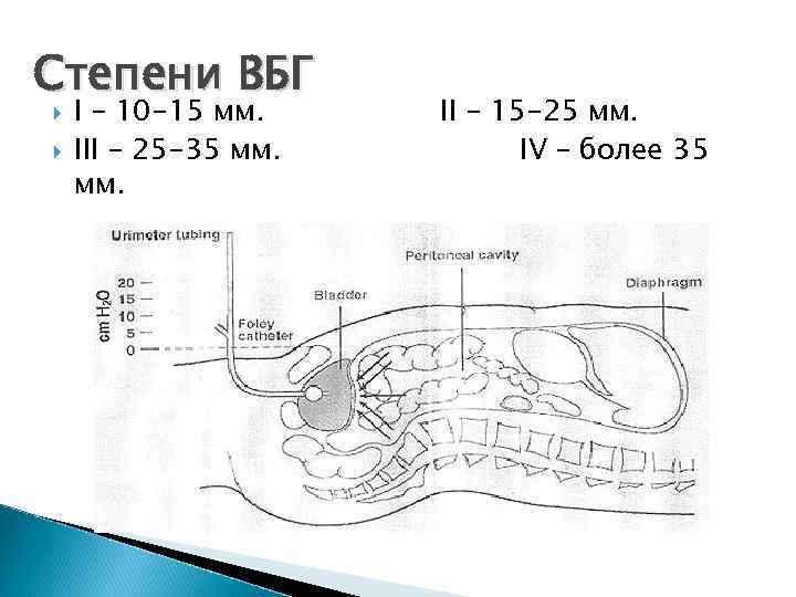 Степени ВБГ I – 10 -15 мм. III – 25 -35 мм. II –