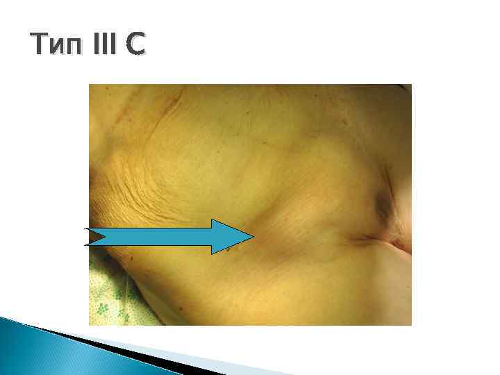 Тип III C 