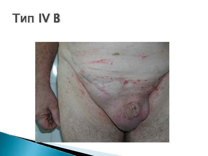 Тип IV B 