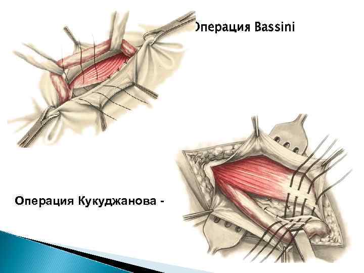 Пластика по бассини при паховой грыже