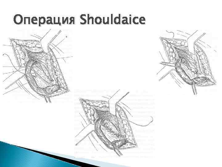 Операция Shouldaice 