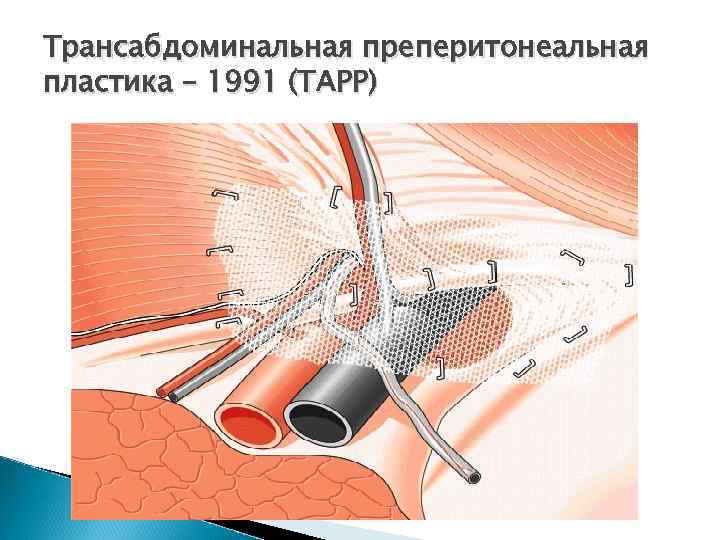 Трансабдоминальная преперитонеальная пластика – 1991 (ТАРР) 