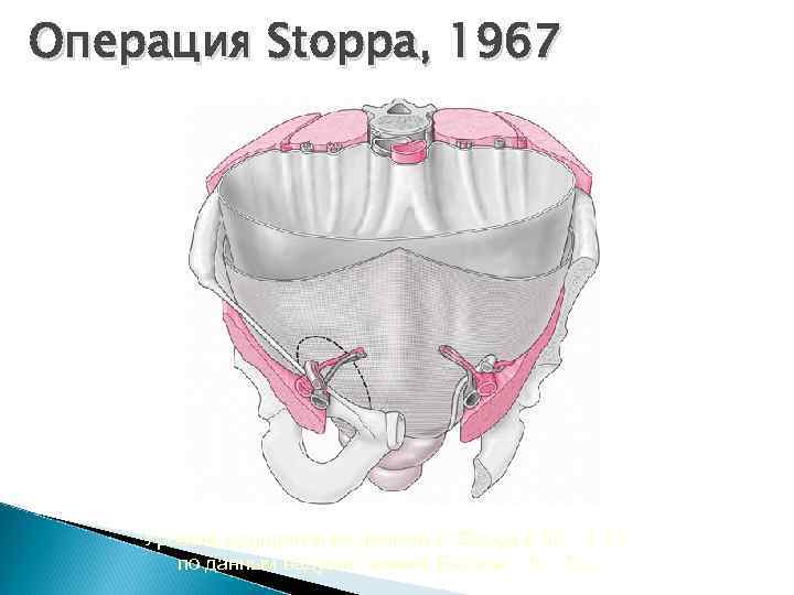 Операция Stoppa, 1967 Уровень рецидивов по данным R. Stoppa 0, 56 – 1, 1%
