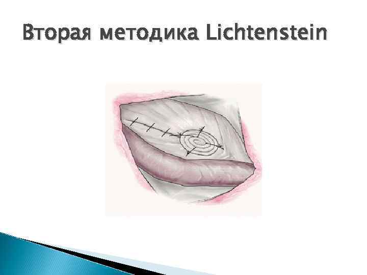 Вторая методика Lichtenstein 