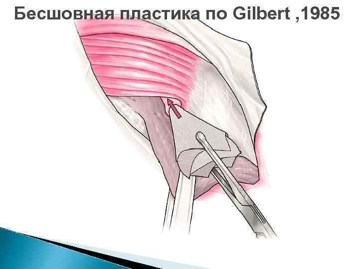 Бесшовная пластика по Gilbert , 1985 