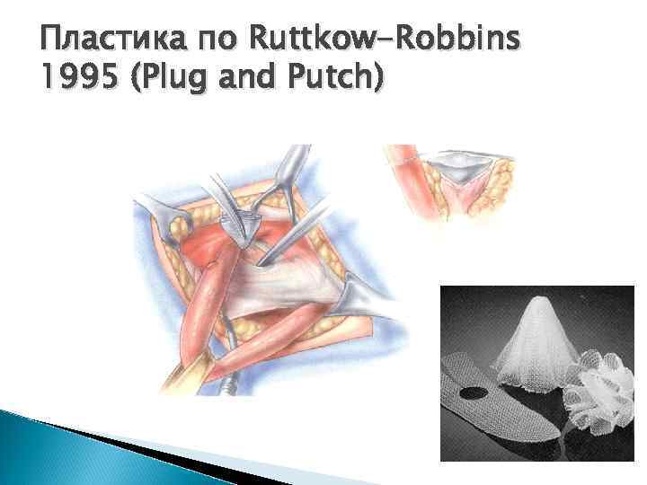 Пластика по Ruttkow-Robbins 1995 (Plug and Putch) 