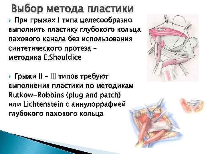 Выбор метода пластики При грыжах I типа целесообразно выполнить пластику глубокого кольца пахового канала