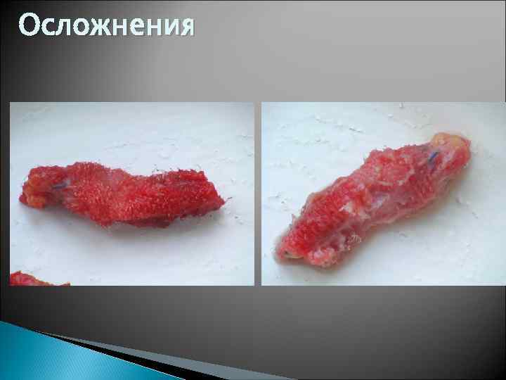 Осложнения 