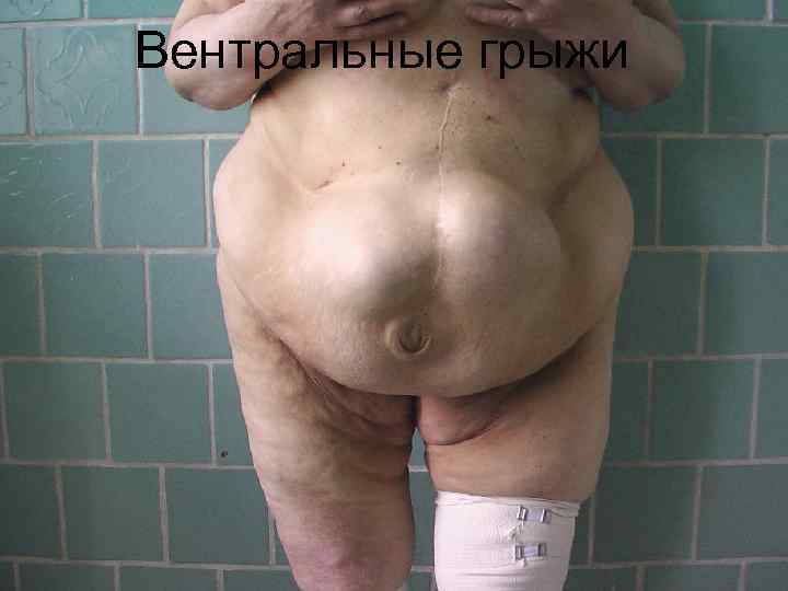 Вентральные грыжи 