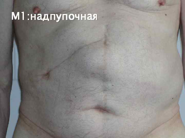 М 1: надпупочная 