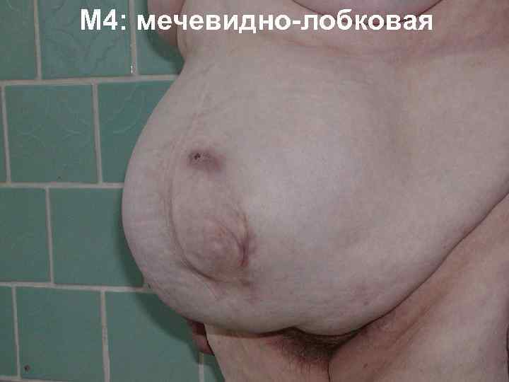 M 4: мечевидно лобковая 