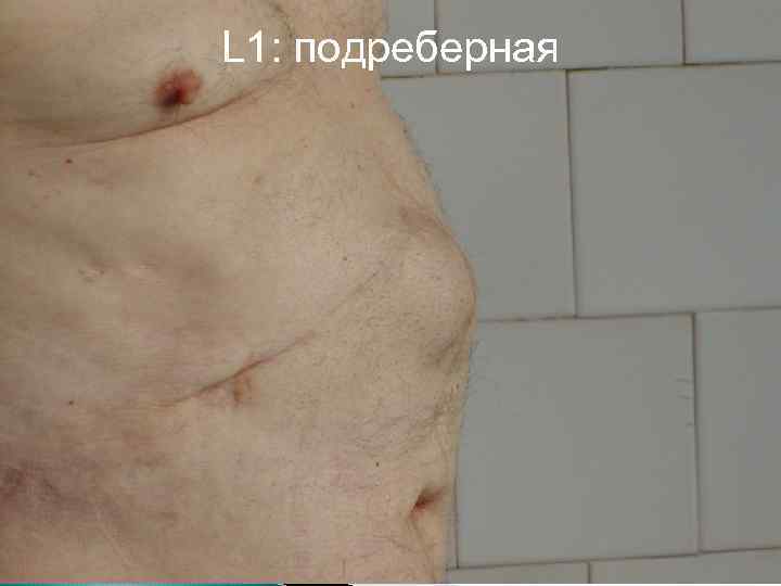 L 1: подреберная 