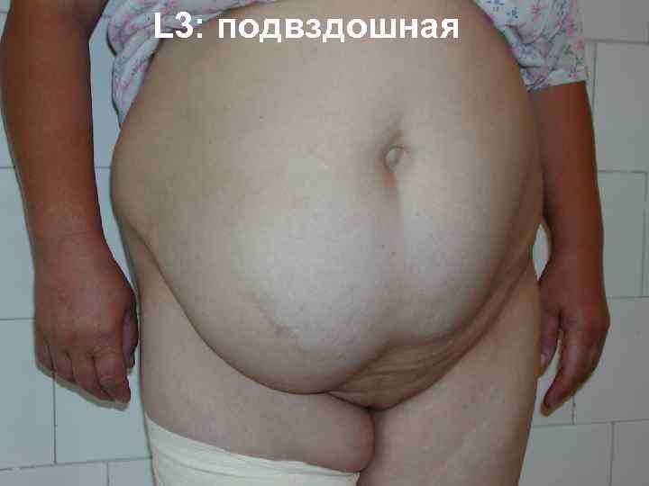 L 3: подвздошная 