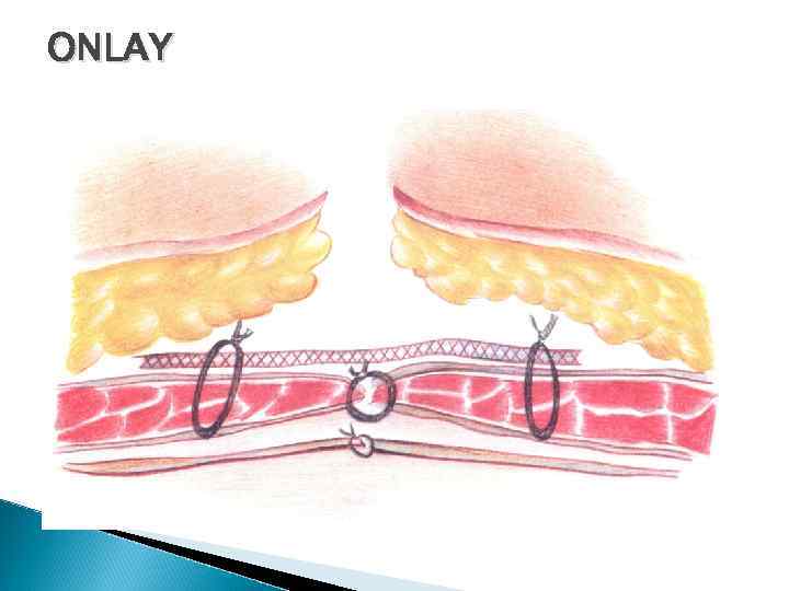 ONLAY 