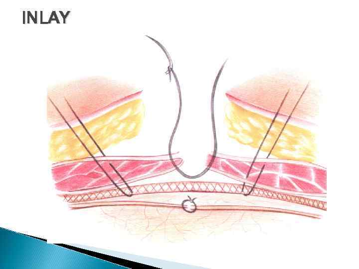 INLAY 