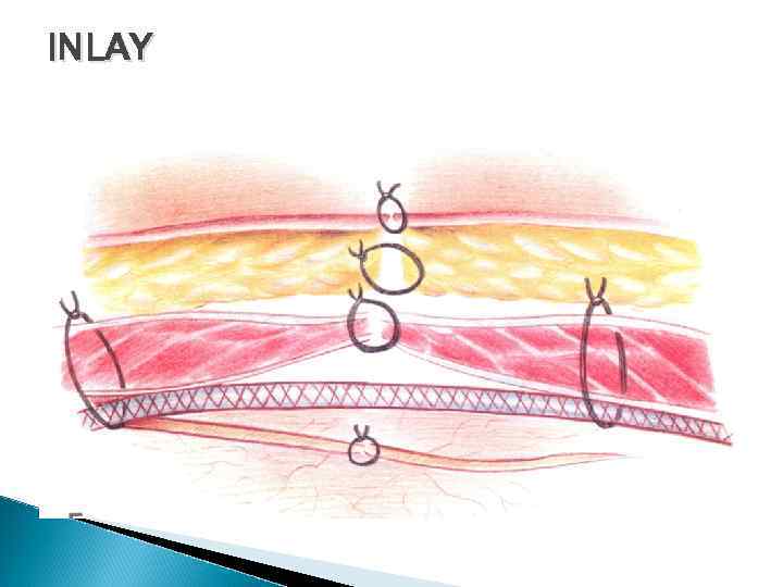 INLAY 