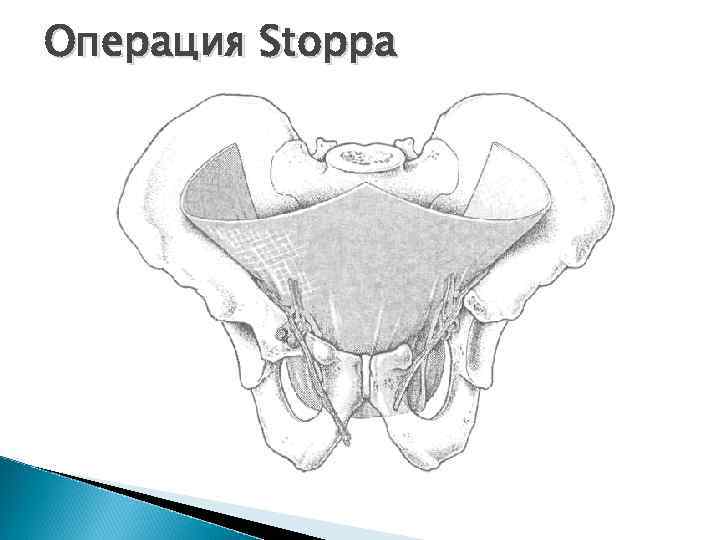 Операция Stoppa 