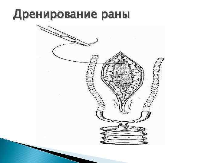 Дренирование раны 