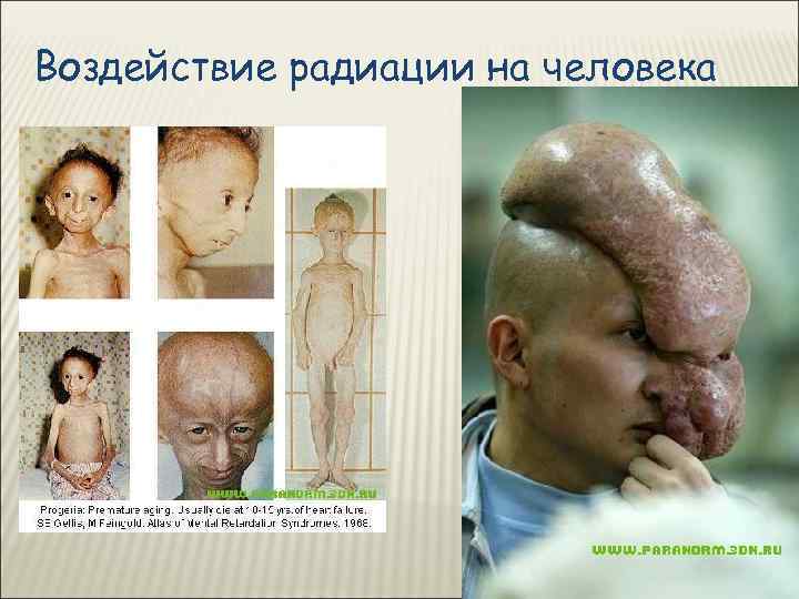 Воздействие радиации на человека 