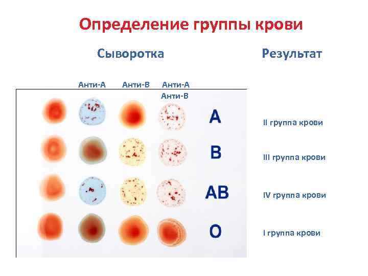 Определение группы крови Сыворотка Анти-А Анти-В Результат Анти-А Анти-В II группа крови IV группа