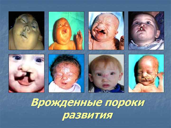 Врожденные пороки развития 