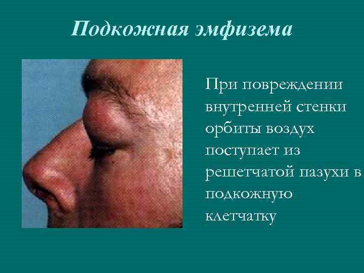 Подкожная эмфизема При повреждении внутренней стенки орбиты воздух поступает из решетчатой пазухи в подкожную