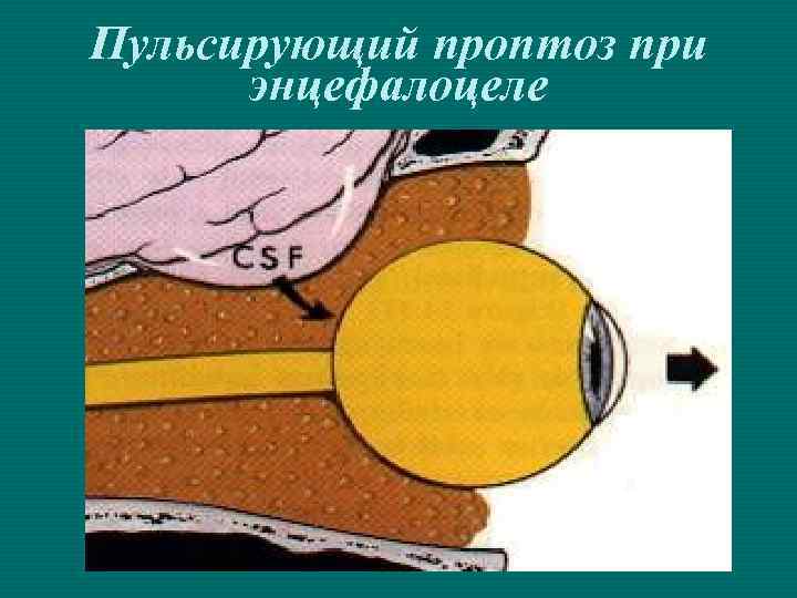 Пульсирующий проптоз при энцефалоцеле 