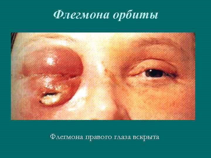 Флегмона орбиты Флегмона правого глаза вскрыта 