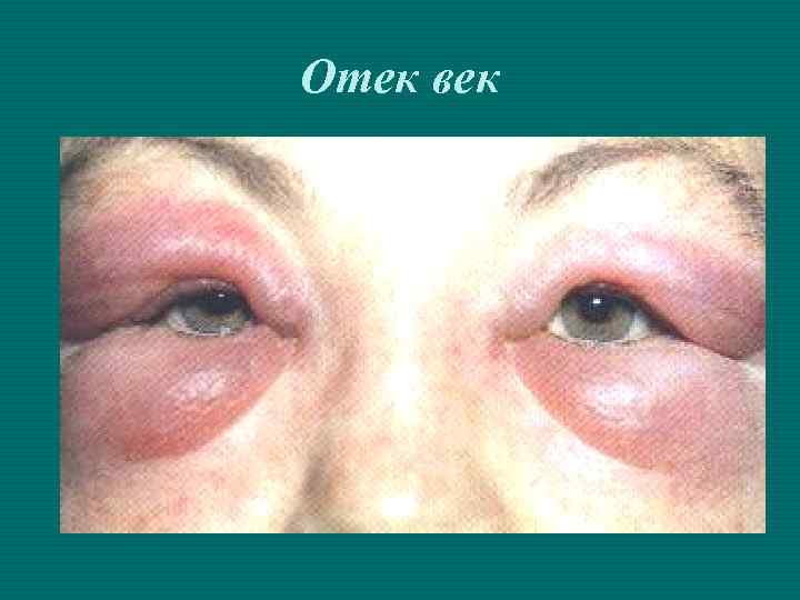 Отек век 