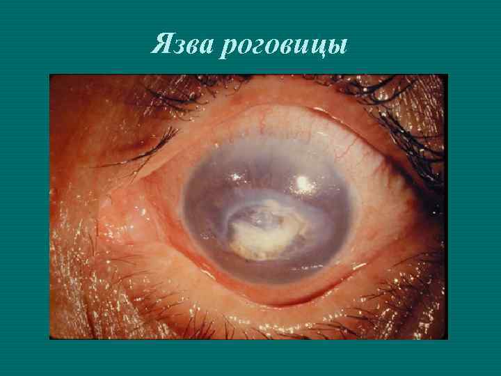 Язва роговицы 