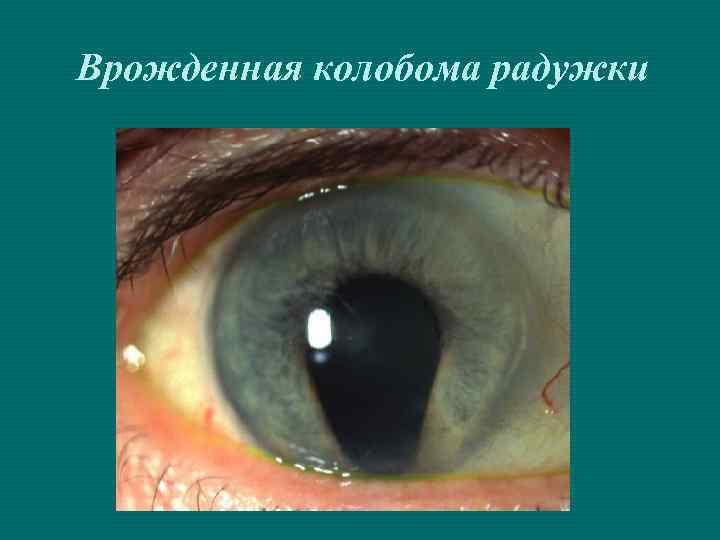 Врожденная колобома радужки 