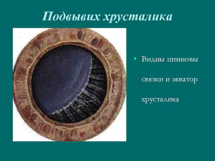 Подвывих хрусталика • Видны цинновы связки и экватор хрусталика 