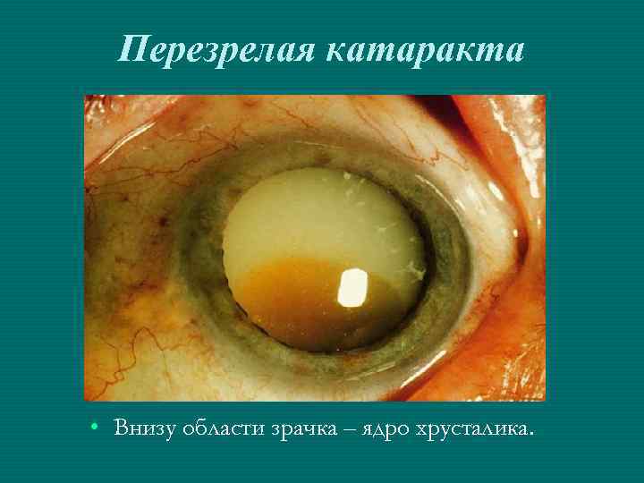 Перезрелая катаракта • Внизу области зрачка – ядро хрусталика. 
