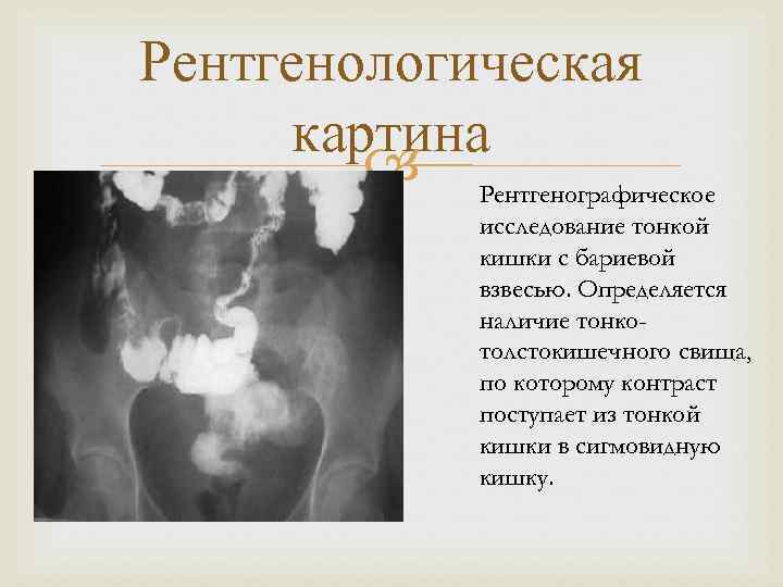 Рентгенологическая картина Рентгенографическое исследование тонкой кишки с бариевой взвесью. Определяется наличие тонкотолстокишечного свища, по