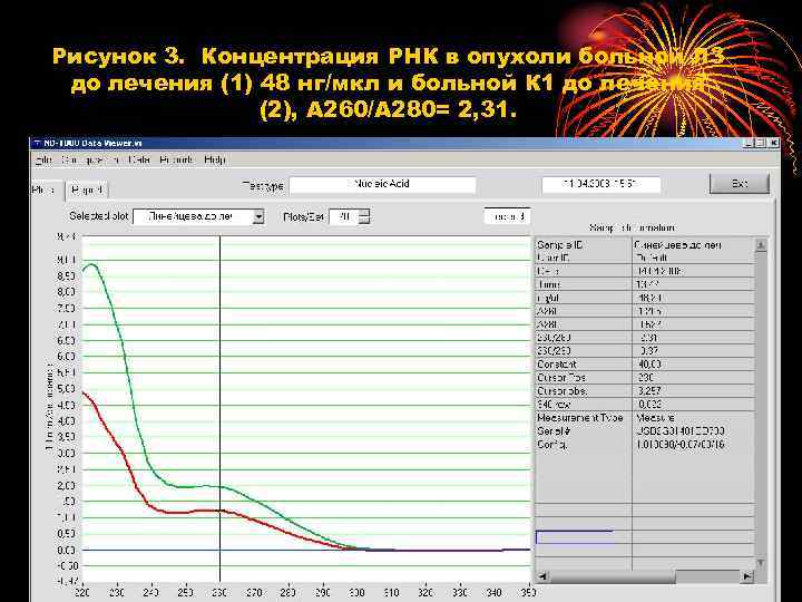 Рисунок 3. Концентрация РНК в опухоли больной Л 3 до лечения (1) 48 нг/мкл
