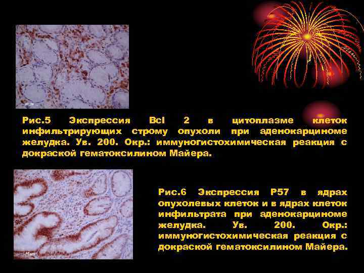 Рис. 5 Экспрессия Bcl 2 в цитоплазме клеток инфильтрирующих строму опухоли при аденокарциноме желудка.