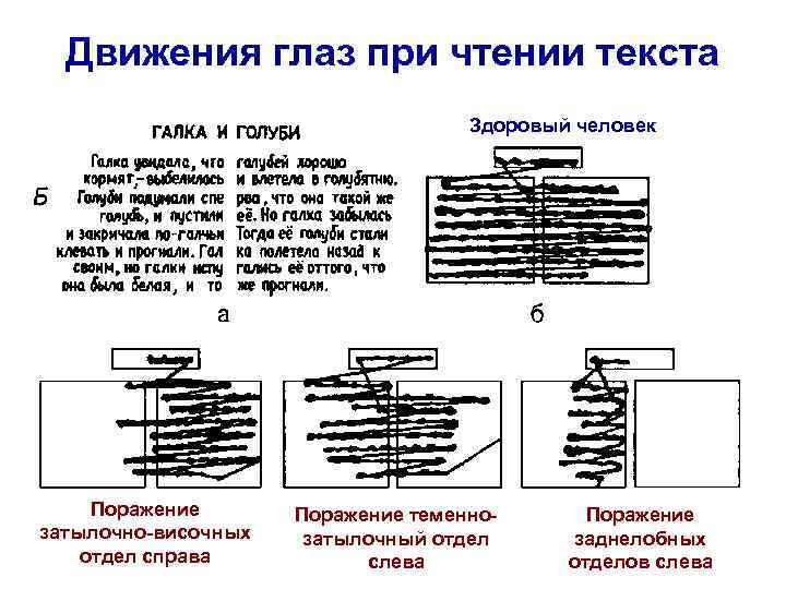 Движения глаз при чтении текста Здоровый человек Поражение затылочно-височных отдел справа Поражение теменнозатылочный отдел
