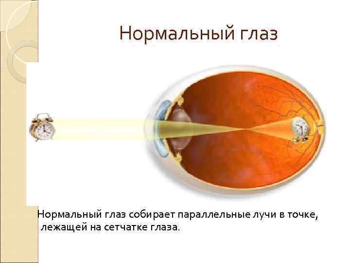 Нормальный глаз собирает параллельные лучи в точке, лежащей на сетчатке глаза. 
