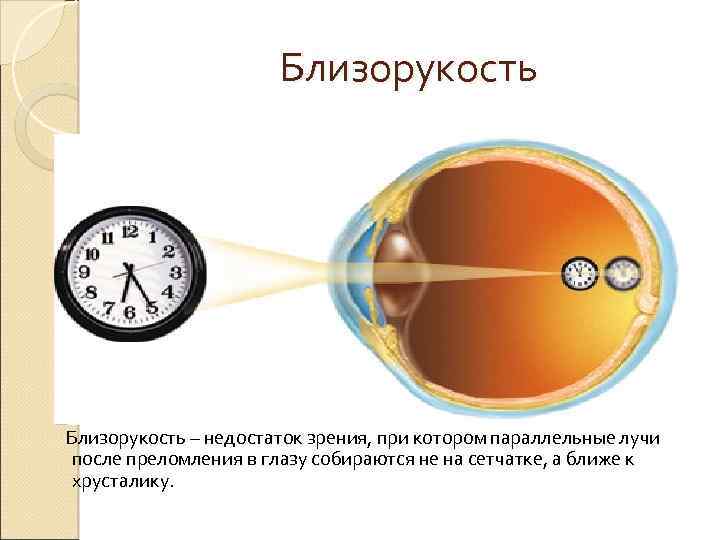Близорукость – недостаток зрения, при котором параллельные лучи после преломления в глазу собираются не