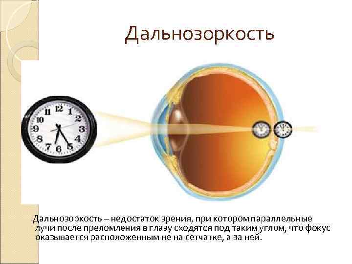 Дальнозоркость – недостаток зрения, при котором параллельные лучи после преломления в глазу сходятся под