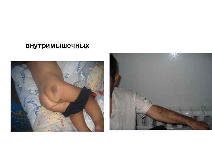 внутримышечных 